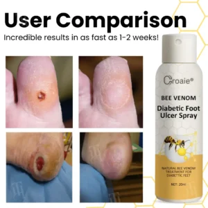 Croaie® Bee Venom Diabetic Foot Ulcer Spray✅ 𝐕𝐢𝐬𝐢𝐛𝐥𝐞 𝐢𝐦𝐩𝐫𝐨𝐯𝐞𝐦𝐞𝐧𝐭 𝐢𝐧 𝟐-𝟑 𝐰𝐞𝐞𝐤𝐬✅