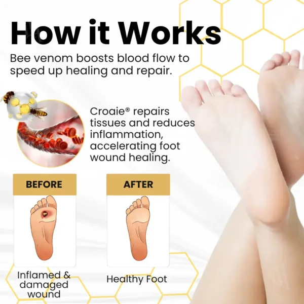 Croaie® Bee Venom Diabetic Foot Ulcer Spray✅ 𝐕𝐢𝐬𝐢𝐛𝐥𝐞 𝐢𝐦𝐩𝐫𝐨𝐯𝐞𝐦𝐞𝐧𝐭 𝐢𝐧 𝟐-𝟑 𝐰𝐞𝐞𝐤𝐬✅