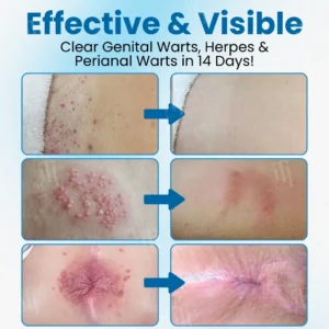 Croaie® Nanolipo Genital Warts Relief Cream🚀𝐂𝐨𝐦𝐩𝐥𝐞𝐭𝐞 𝐆𝐞𝐧𝐢𝐭𝐚𝐥 𝐑𝐞𝐬𝐭𝐨𝐫𝐚𝐭𝐢𝐨𝐧 𝐢𝐧 𝟏𝟒 𝐃𝐚𝐲𝐬🚀
