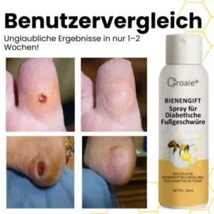 Croaie® Bienengift Spray für Diabetische Fußgeschwüre✔𝐬𝐢𝐜𝐡𝐭𝐛𝐚𝐫𝐞 𝐕𝐞𝐫𝐛𝐞𝐬𝐬𝐞𝐫𝐮𝐧𝐠 𝐢𝐧 𝟐-𝟑 𝐖𝐨𝐜𝐡𝐞𝐧✔