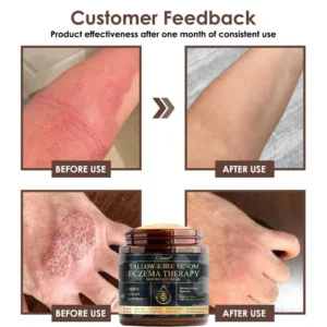 🔥FDA Approved⭐ WHO Approved🌍 Croaie® Tallow & Bee venom Eczema Theraphy