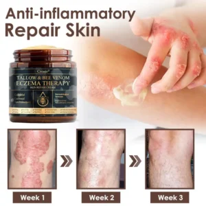 🔥FDA Approved⭐ WHO Approved🌍 Croaie® Tallow & Bee venom Eczema Theraphy