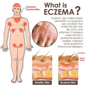 🔥FDA Approved⭐ WHO Approved🌍 Croaie® Tallow & Bee venom Eczema Theraphy