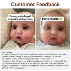 🔥FDA Approved⭐ WHO Approved🌍 Croaie® Tallow & Bee venom Eczema Theraphy