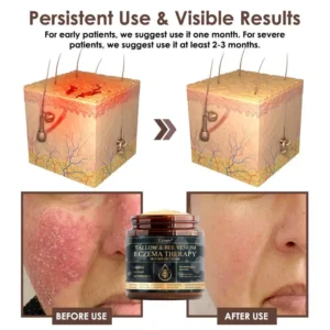 🔥FDA Approved⭐ WHO Approved🌍 Croaie® Tallow & Bee venom Eczema Theraphy