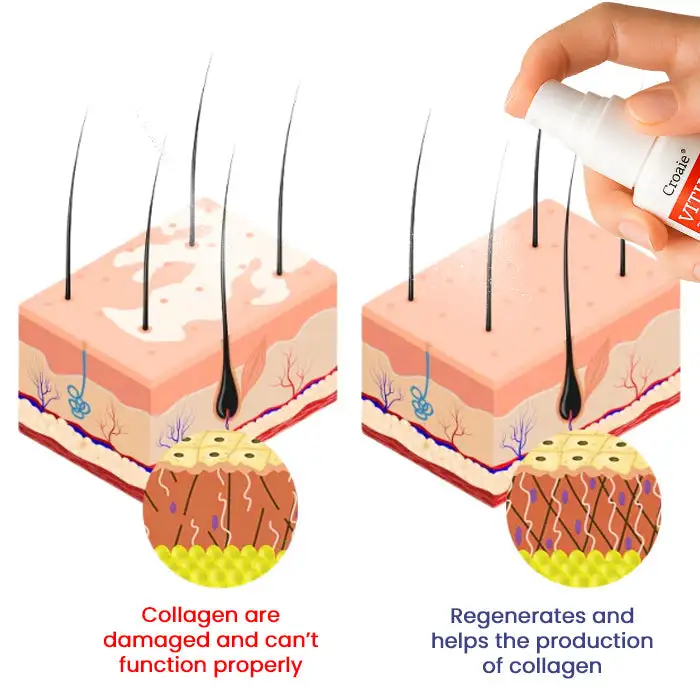 🔥FDA Approved⭐ WHO Approved🌍 Croaie® Vitiligo Treatment Spray - No allergies🌸 Quick and effective⚡️ With over 150,000 sold!📦