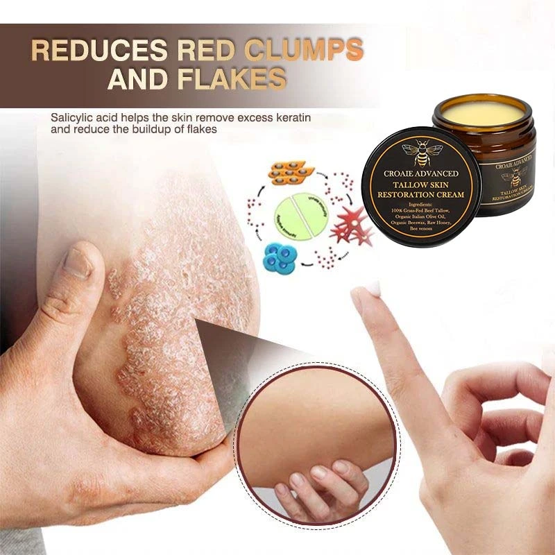 CROAIE ADVANCEDยฎ ๐๐ฌ๐จ๐ซ๐ข๐๐ฌ๐ข๐ฌ & ๐๐๐ณ๐๐ฆ๐ ๐๐๐ฅ๐ข๐๐ ๐๐ซ๐๐๐ฆ ๐โ
Clinically Proven ๐ฉโโ๏ธDermatologist Trusted ยท ๐บ๐ธFDA Certification