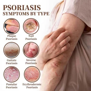 CROAIE ADVANCEDยฎ ๐๐ฌ๐จ๐ซ๐ข๐๐ฌ๐ข๐ฌ & ๐๐๐ณ๐๐ฆ๐ ๐๐๐ฅ๐ข๐๐ ๐๐ซ๐๐๐ฆ ๐โ
Clinically Proven ๐ฉโโ๏ธDermatologist Trusted ยท ๐บ๐ธFDA Certification