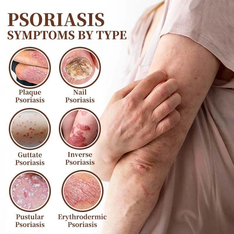 CROAIE ADVANCEDยฎ ๐๐ฌ๐จ๐ซ๐ข๐๐ฌ๐ข๐ฌ & ๐๐๐ณ๐๐ฆ๐ ๐๐๐ฅ๐ข๐๐ ๐๐ซ๐๐๐ฆ ๐โ
Clinically Proven ๐ฉโโ๏ธDermatologist Trusted ยท ๐บ๐ธFDA Certification