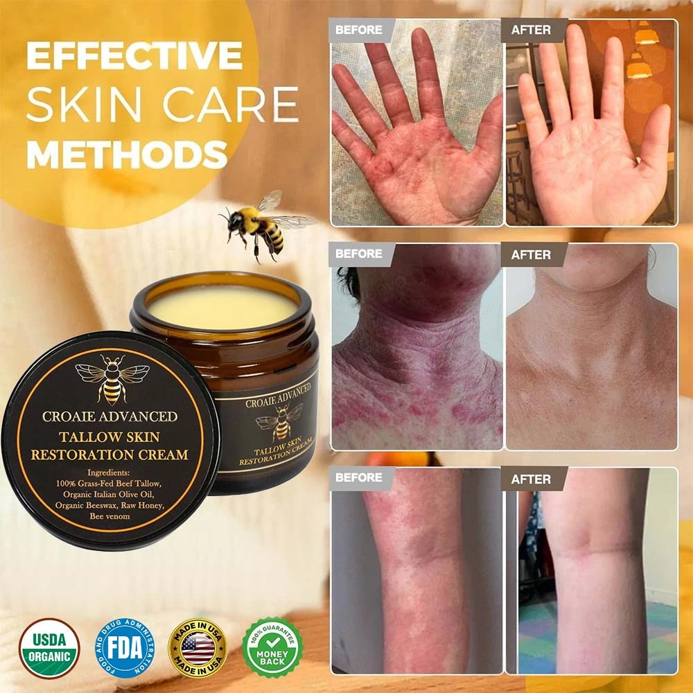 CROAIE ADVANCEDยฎ ๐๐ฌ๐จ๐ซ๐ข๐๐ฌ๐ข๐ฌ & ๐๐๐ณ๐๐ฆ๐ ๐๐๐ฅ๐ข๐๐ ๐๐ซ๐๐๐ฆ ๐โ
Clinically Proven ๐ฉโโ๏ธDermatologist Trusted ยท ๐บ๐ธFDA Certification