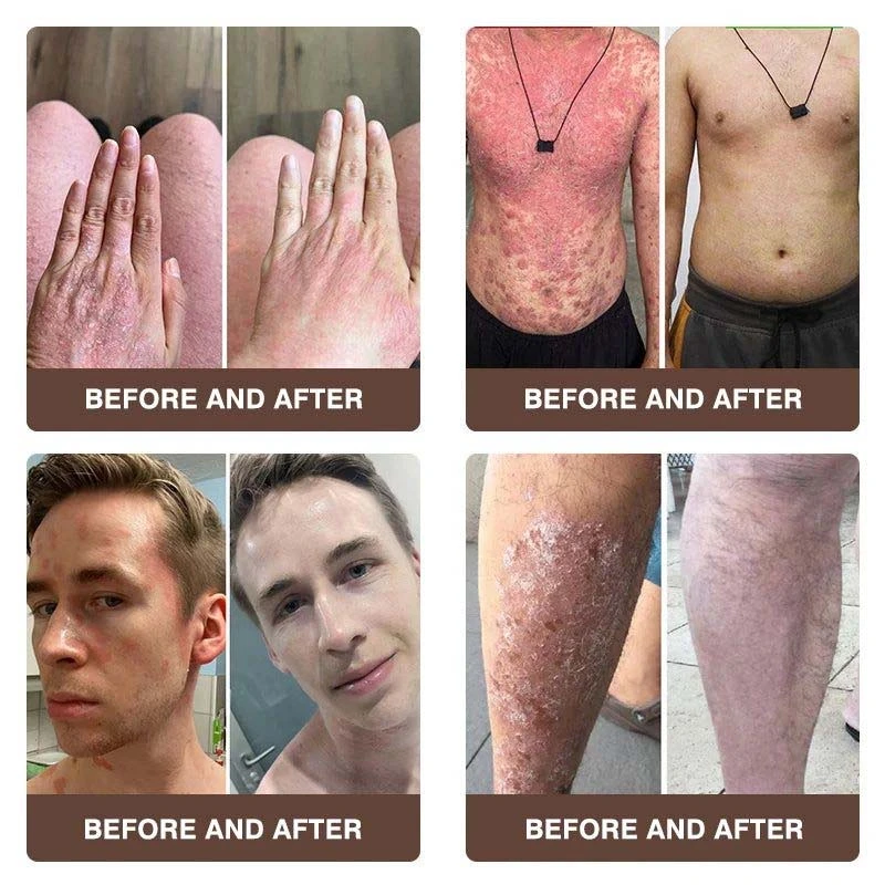 CROAIE ADVANCEDยฎ ๐๐ฌ๐จ๐ซ๐ข๐๐ฌ๐ข๐ฌ & ๐๐๐ณ๐๐ฆ๐ ๐๐๐ฅ๐ข๐๐ ๐๐ซ๐๐๐ฆ ๐โ
Clinically Proven ๐ฉโโ๏ธDermatologist Trusted ยท ๐บ๐ธFDA Certification