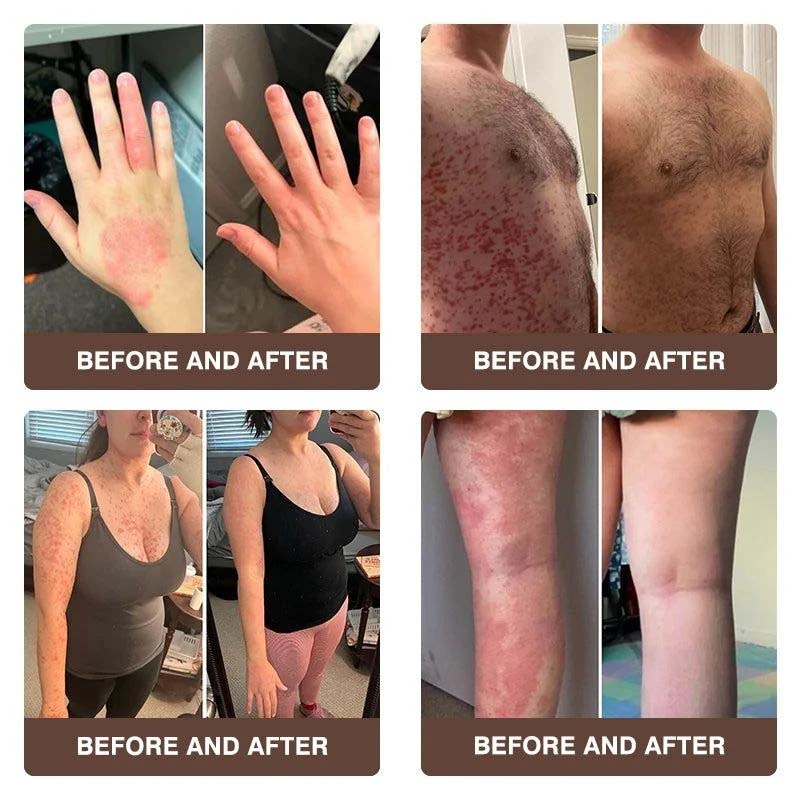 CROAIE ADVANCEDยฎ ๐๐ฌ๐จ๐ซ๐ข๐๐ฌ๐ข๐ฌ & ๐๐๐ณ๐๐ฆ๐ ๐๐๐ฅ๐ข๐๐ ๐๐ซ๐๐๐ฆ ๐โ
Clinically Proven ๐ฉโโ๏ธDermatologist Trusted ยท ๐บ๐ธFDA Certification