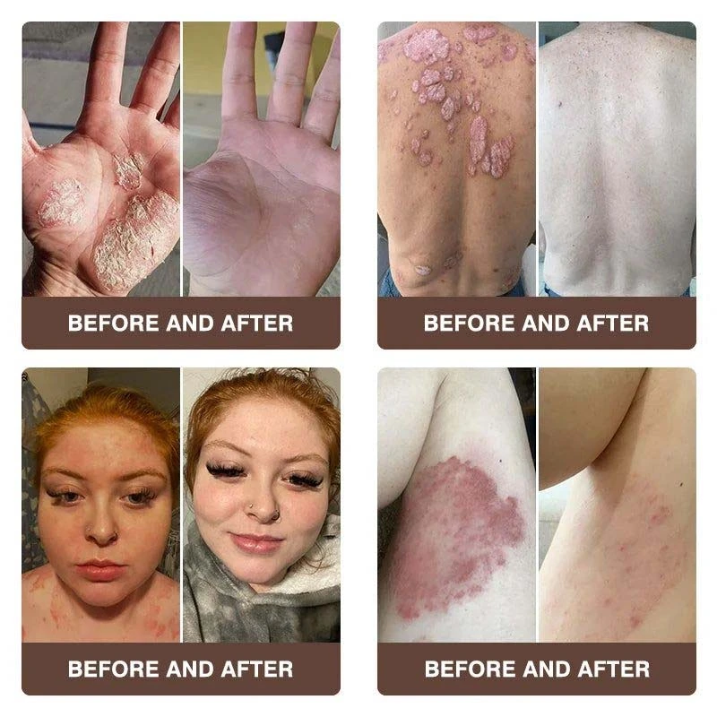 CROAIE ADVANCEDยฎ ๐๐ฌ๐จ๐ซ๐ข๐๐ฌ๐ข๐ฌ & ๐๐๐ณ๐๐ฆ๐ ๐๐๐ฅ๐ข๐๐ ๐๐ซ๐๐๐ฆ ๐โ
Clinically Proven ๐ฉโโ๏ธDermatologist Trusted ยท ๐บ๐ธFDA Certification