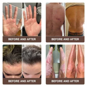 CROAIE ADVANCEDยฎ ๐๐ฌ๐จ๐ซ๐ข๐๐ฌ๐ข๐ฌ & ๐๐๐ณ๐๐ฆ๐ ๐๐๐ฅ๐ข๐๐ ๐๐ซ๐๐๐ฆ ๐โ
Clinically Proven ๐ฉโโ๏ธDermatologist Trusted ยท ๐บ๐ธFDA Certification