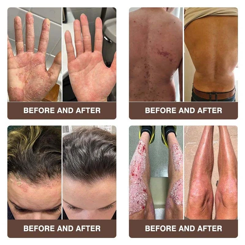 CROAIE ADVANCEDยฎ ๐๐ฌ๐จ๐ซ๐ข๐๐ฌ๐ข๐ฌ & ๐๐๐ณ๐๐ฆ๐ ๐๐๐ฅ๐ข๐๐ ๐๐ซ๐๐๐ฆ ๐โ
Clinically Proven ๐ฉโโ๏ธDermatologist Trusted ยท ๐บ๐ธFDA Certification