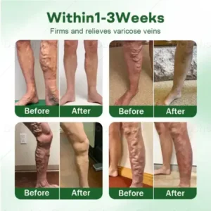 Croaie® VeinLock Microneedle Patch