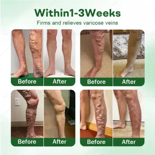 Croaie® VeinLock Microneedle Patch