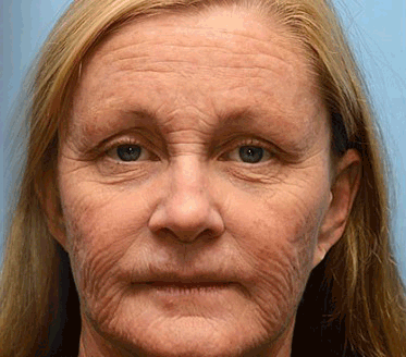 ⏰ Last Day! 70% OFF 💫 Rolimey® Botox & Vita-A Retinol Wrinkle-Lift Cream – Made & Shipped from CA 🔥